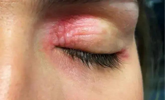 Queimaduras nos olhos