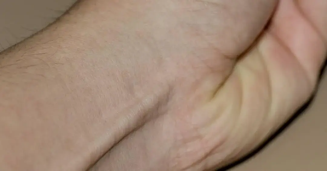 Perda de função muscular